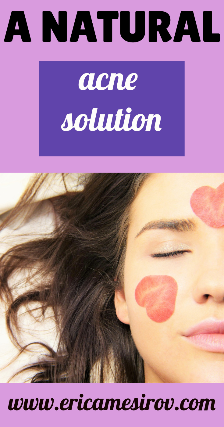 A natural acne solution (food sensitivities and pimples/ natural acne remedy/ drugs for acne/ creams for pimples/ creams for breakouts/ what to use when you break out/ foods that cause acne/ why your skin is still breaking out/ sugar and pimples)